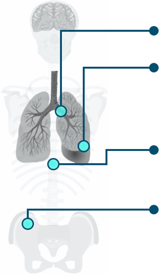 LIBTAYO® (cemiplimab-rwlc) Hypothetical Patient Profile - Nora